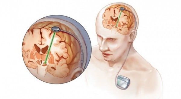 Deep-brain-stimulation-640x353[1]