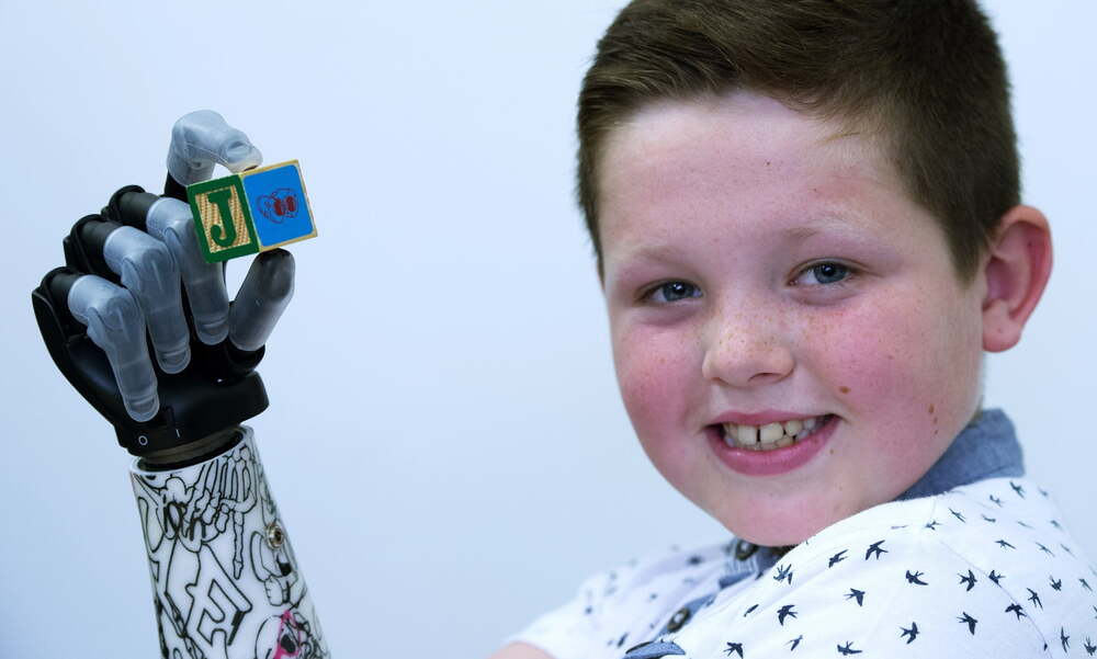 9 yasinda cocuga biyonik kol 1